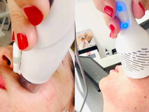 RF arckezelés: Az Apollon Beauty kozmetika modern technológiája