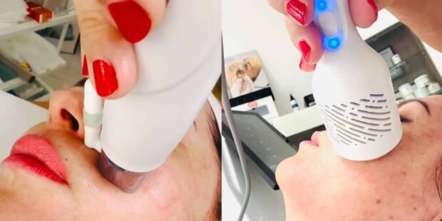 RF arckezelés: Az Apollon Beauty kozmetika modern technológiája