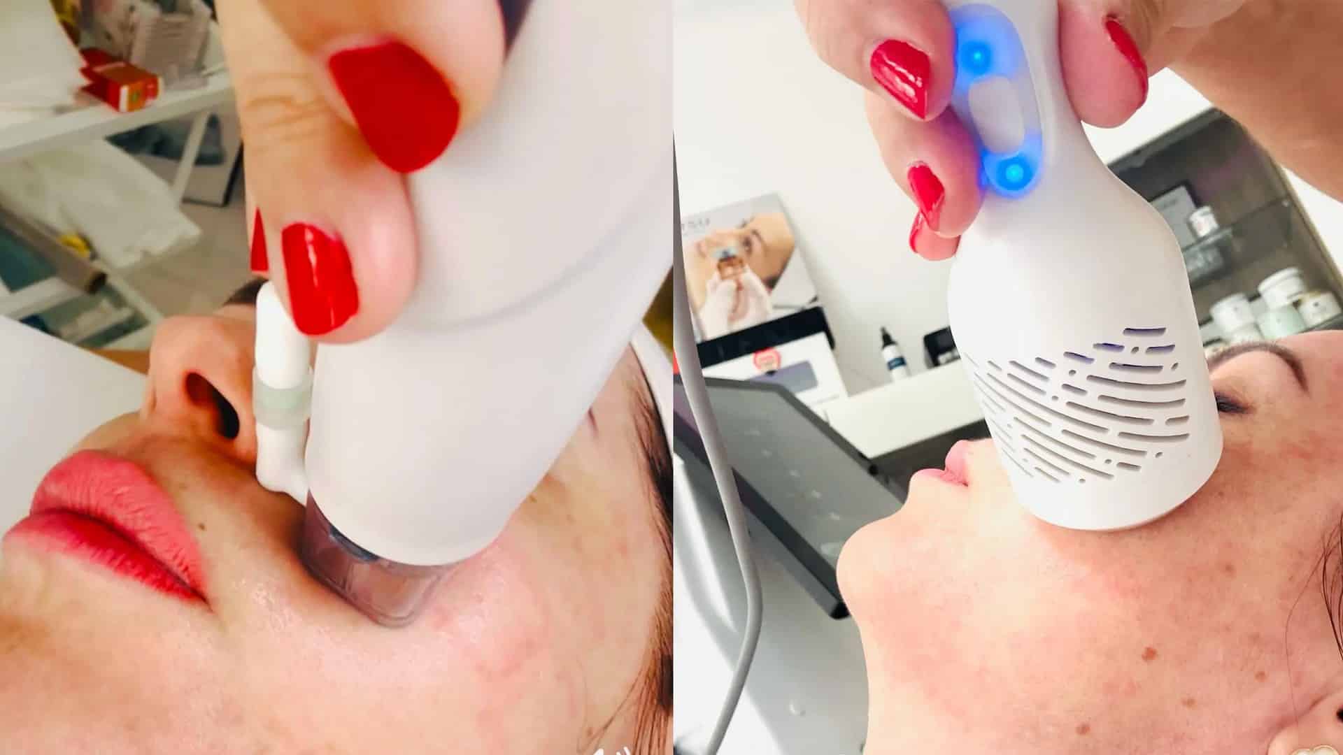 RF arckezelés: Az Apollon Beauty kozmetika modern technológiája